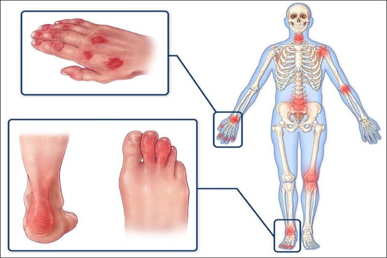 psoriatic arthritis